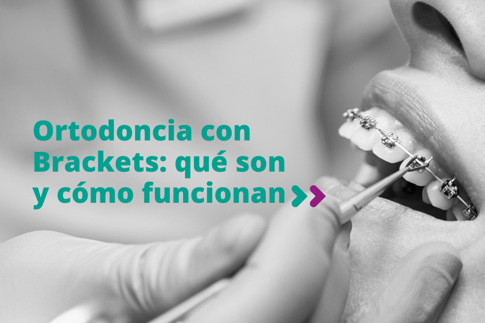 Ortodoncia con brackets: qué son y cómo funcionan