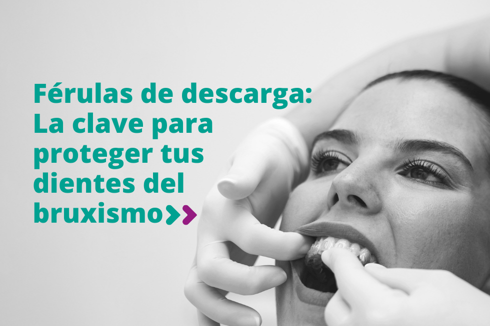 Férulas de descarga: La clave para proteger tus dientes del bruxismo